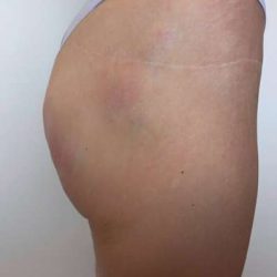Non-Surgical BBLs Before & After Patient #987
