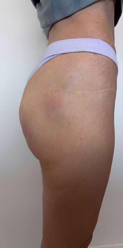 Non-Surgical BBLs Before & After Patient #987