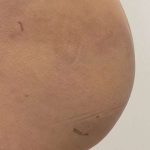 Non-Surgical BBLs Before & After Patient #990