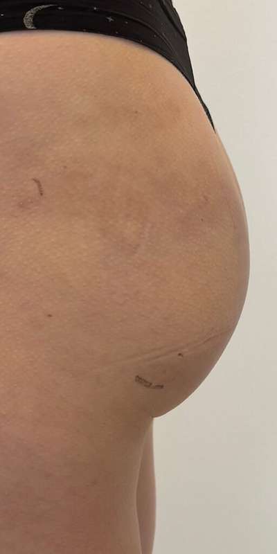 Non-Surgical BBLs Before & After Patient #990