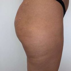 Non-Surgical BBLs Before & After Patient #993