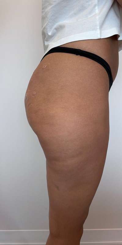 Non-Surgical BBLs Before & After Patient #993