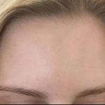 Botox/Dysport Before & After Patient #840