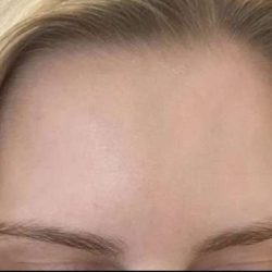 Botox/Dysport Before & After Patient #840