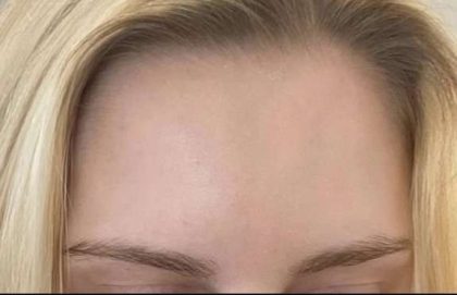 Botox/Dysport Before & After Patient #840