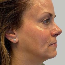 HALO/BBL Before & After Patient #1002
