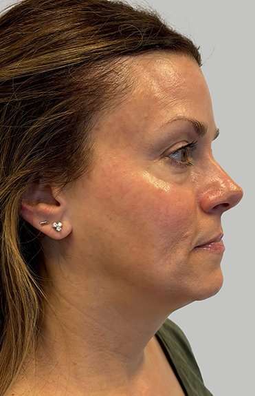 HALO/BBL Before & After Patient #1002