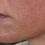 HALO/BBL Before & After Patient #1008