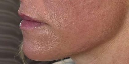 HALO/BBL Before & After Patient #1008