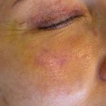 HALO/BBL Before & After Patient #1013