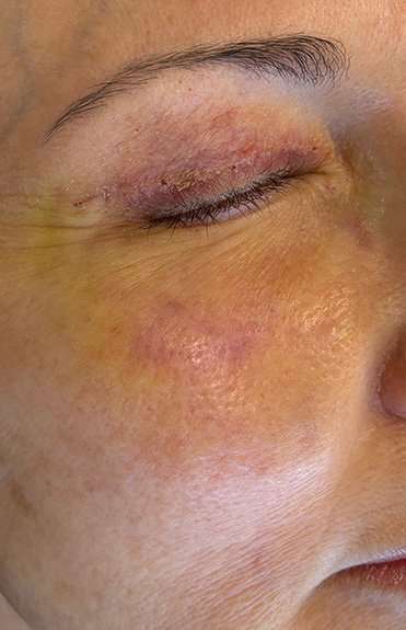HALO/BBL Before & After Patient #1013
