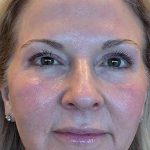 HALO/BBL Before & After Patient #1018