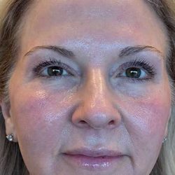 HALO/BBL Before & After Patient #1018