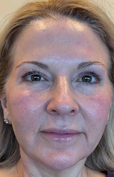 HALO/BBL Before & After Patient #1018