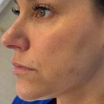HALO/BBL Before & After Patient #1021