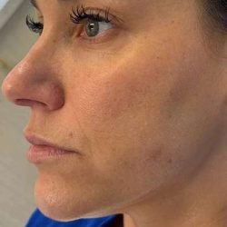Microneedling + RF Before & After Patient #1024