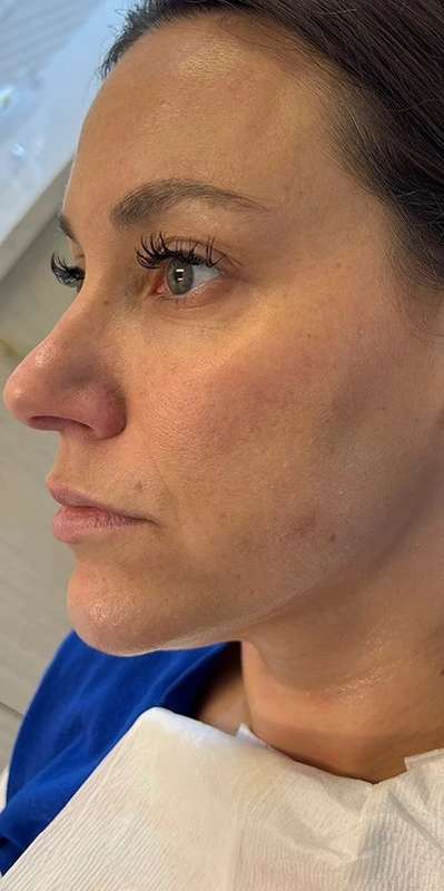 Microneedling + RF Before & After Patient #1024