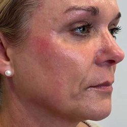 Microneedling + RF Before & After Patient #1027