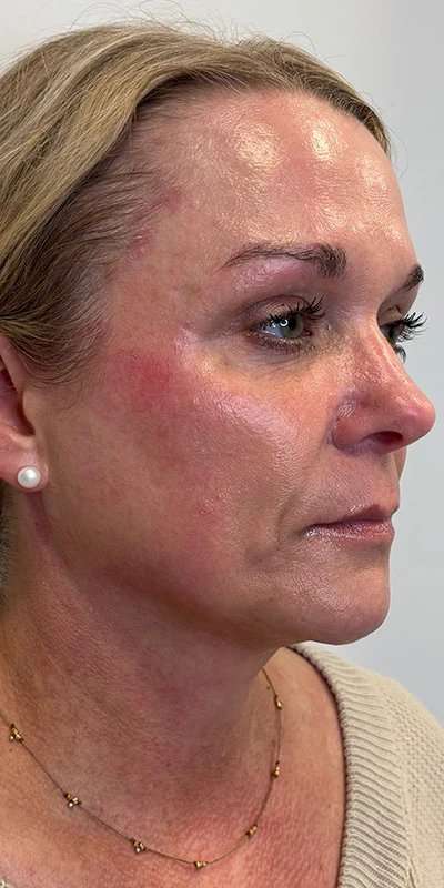 Microneedling + RF Before & After Patient #1027
