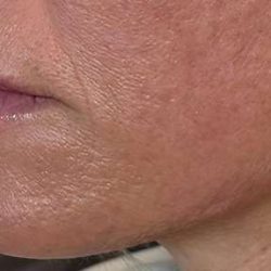 SkinPen Microneedling Before & After Patient #1030