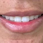 Botox/Dysport Before & After Patient #843
