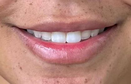 Botox/Dysport Before & After Patient #843