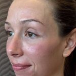 SkinPen Microneedling Before & After Patient #1033