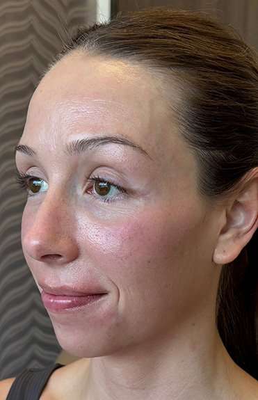 SkinPen Microneedling Before & After Patient #1033