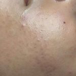 Facials Before & After Patient #1036