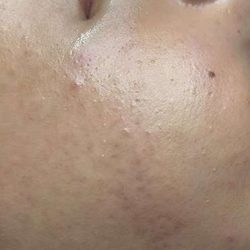 Facials Before & After Patient #1036