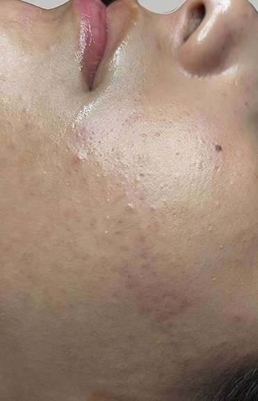 Facials Before & After Patient #1036