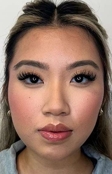 Botox/Dysport Before & After Patient #846