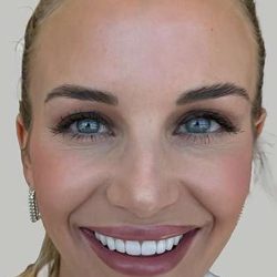 Botox/Dysport Before & After Patient #851