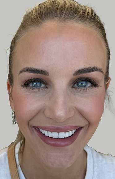 Botox/Dysport Before & After Patient #851