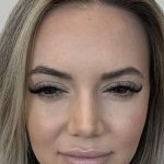 Botox/Dysport Before & After Patient #856