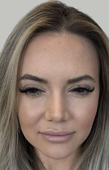 Botox/Dysport Before & After Patient #856