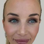 Botox/Dysport Before & After Patient #851
