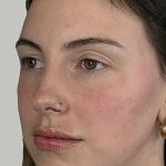 Full Facial Balancing Before & After Patient #914