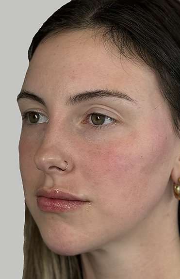 Full Facial Balancing Before & After Patient #914