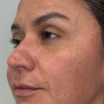 Full Facial Balancing Before & After Patient #924