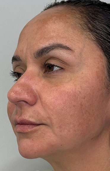 Full Facial Balancing Before & After Patient #924