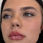 Lip Filler Before & After Patient #952