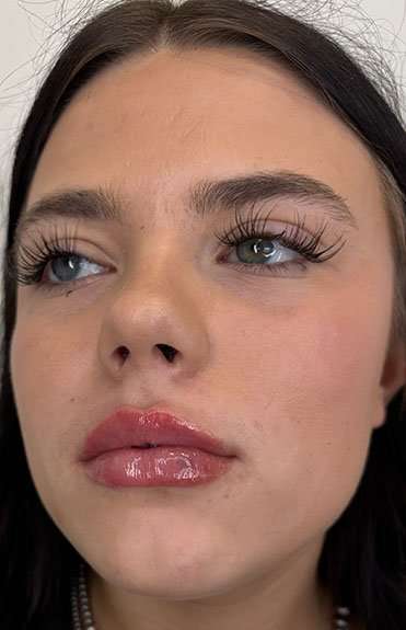 Lip Filler Before & After Patient #952