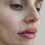 Lip Filler Before & After Patient #965