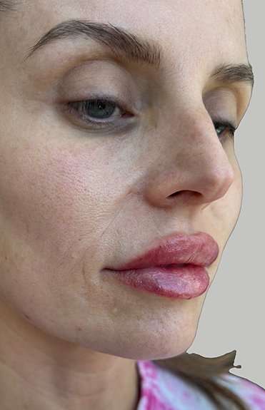 Lip Filler Before & After Patient #965