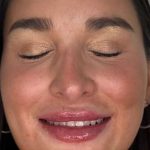 Lip Filler Before & After Patient #981