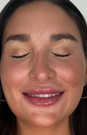 Lip Filler Before & After Patient #981