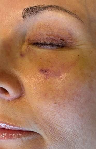 HALO/BBL Before & After Patient #1013