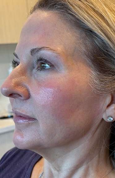 HALO/BBL Before & After Patient #1018
