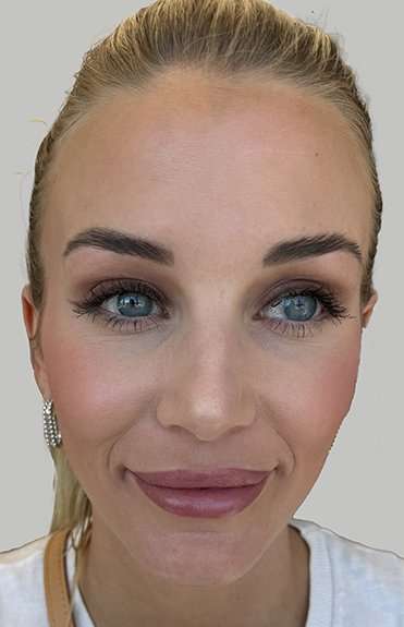Botox/Dysport Before & After Patient #851
